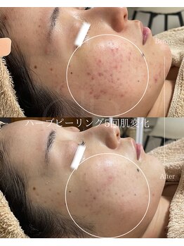 アニール(aniR)/ハーブピーリング/ニキビケア