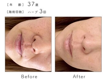 チップ(chip)/37歳/施術3回