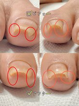 カンパニュラ(Campanula)/巻き爪ケア