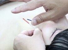 ヘルシースリムウエダ/施術風景【ひばりが丘/美容鍼】