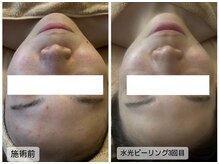サンテ パシャ(Sante Pasha)の雰囲気（水光ピーリングで水光肌へ肌質改善☆効果はInstagramより☆）