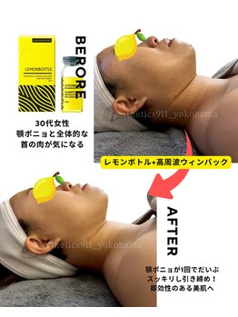エステティックス ナインワンワン 横浜(Esthetics911) /レモンボトルで小顔リフトアップ