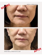 ユーフォリア(Euphoria)/リフトアップ効果、１回で実感