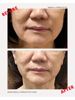 ユーフォリア(Euphoria)/リフトアップ効果、1回で実感