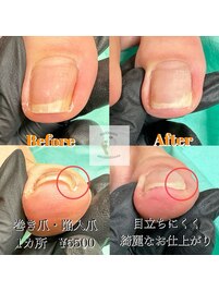 巻き爪　陥入爪