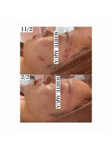 ホワイトアクア 加古川店(WHITE AQUA)/ハーブピーリングで肌荒れ改善