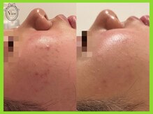 ヴィオール 名古屋栄店(VIOR)/ハーブ　数回で肌質が変わる♪　