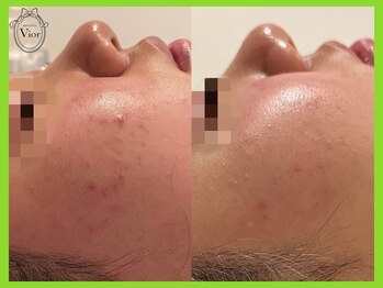 ヴィオール 名古屋栄店(VIOR)/ハーブ 数回で肌質が変わる♪