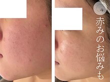 LUNEA/《症例》赤みケア