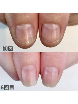 爪噛みによる深爪【2】