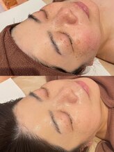 エステテックサロンラレーヌ 小山店(La Reine)/最新韓国肌管理エクソミア