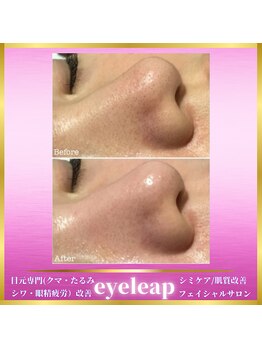 アイリープ(eyeleap)/☆ごっそりハイドロ毛穴洗浄