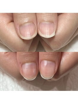 セラキュアネイル(Theracure nail)/自爪育成による変化