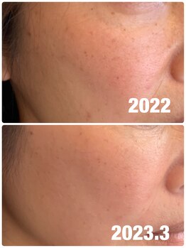 エスポワール(espoir)/ハーブ ピーリング症例