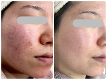 ベルネ(BELLUNE)/ベルネ式肌質改善