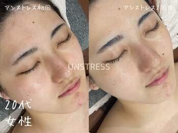ミコサロン(miko salon)/乳酸菌ピーリング