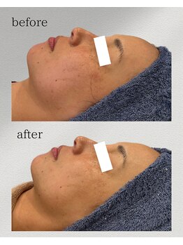 カリス(charis)/お顔の脂肪、浮腫スッキリ☆