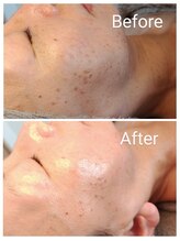 クラリス(Clarice)/エンビロンとピーリングの合せ技