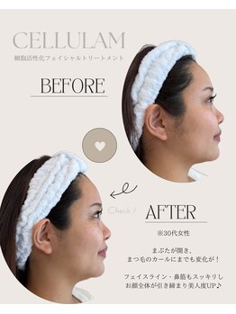 シェリア 桜新町/まぶたのたるみ・リフトアップ