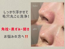 ポアレスラボ ジェンダーレスサロン 横浜の雰囲気（毛穴トラブル改善コスメで角栓をしっかり浮かせて洗浄♪）