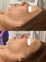 トータルビューティー ミミ(Total Beauty mimi)/輪郭・たるみ・二重顎引き上げ