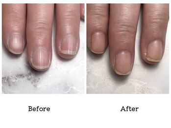 アンベリール(embellir.)/自爪・深爪育成