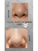 ル シャ/メンズ脱毛/毛穴洗浄/ヘッドスパ