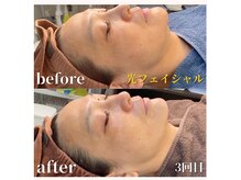 フルーブラン(Frubran)/光フォトで透明感UP◎肌質改善へ