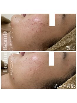 ルルボーテ(Loulou Beaute)/waxxxx+VOSサロンケア