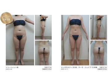 Nビューティー/エンダモロジー×サーモシェイプ