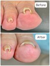 巻き爪矯正ビフォーアフター
