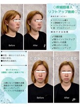 レジュヴィア(Re:JUvia)/幹細胞導入ケア