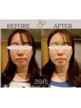 チョコバリ 錦糸町店(chocobari)/小顔×リフトアップ(美容鍼)20代