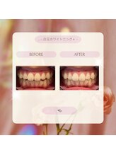 プラスビー 2号店(+b)/ホワイトニングビフォーアフター
