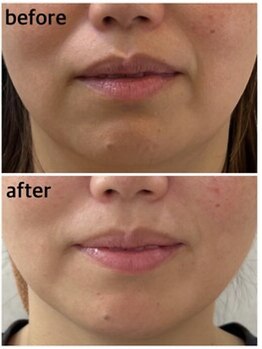 プロッソル こころ(PROSOL)/【NEW】光フェイシャル