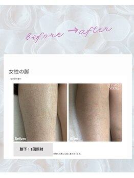 ノノ(nono)/膝下脱毛