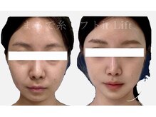 エレグラム(Elegram)/イットリフト施術