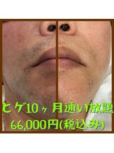 リアンジュ/ヒゲ脱毛の経過