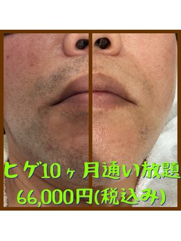 リアンジュ/ヒゲ脱毛の経過