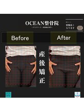 オーシャン整骨院(OCEAN整骨院)/産後矯正の骨盤ビフォーアフター