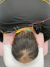 すみだバランス鍼灸整骨院 押上本院/首コリ、肩こりの鍼コース