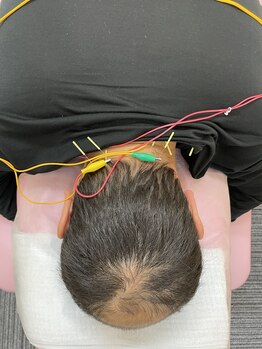 すみだバランス鍼灸整骨院 押上本院/首コリ、肩こりの鍼コース