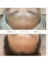 ケイサロン 朝霞店(K salon)/ハーブピーリングbefore・after