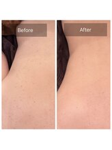 アーユルヴェーダアンドアロマエステ アユス(AYUS)/ハーブピーリング背中