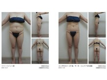 Nビューティー/エンダモロジー×サーモシェイプ