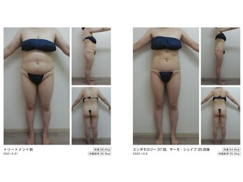 Nビューティー/エンダモロジー×サーモシェイプ