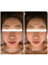 シュシュ(chouchou)/小顔矯正基本コース