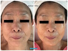 ホノカ(HOnoKA)/EMS＋表情筋ほぐし