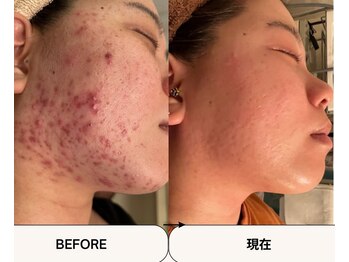 シンデレラ しみケア(Cinderella)/ニキビケア