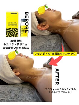 エステティックス ナインワンワン 横浜(Esthetics911) /レモンボトルで小顔リフトアップ
